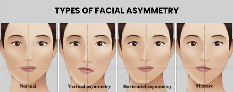 facial asymmetry